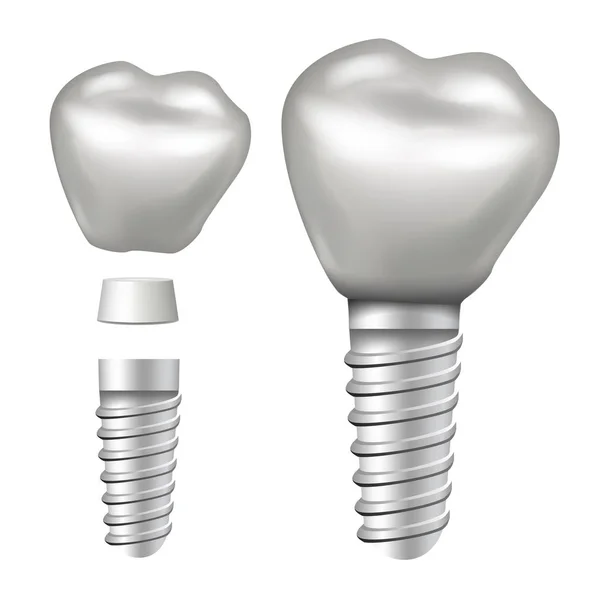 Vetor de Implante Dental. Estrutura do Implante. Crown, Abutment, Screw. Ilustração isolada realista — Vetor de Stock