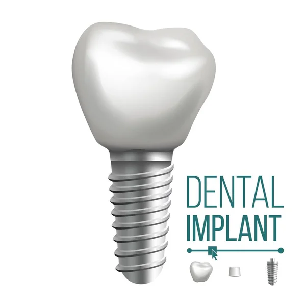 Dental Implant Vector. Molar Human Teeth. Dental Clinic Stomatology Flyer. Realistic Isolated Illustration — Stock Vector