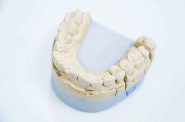 Bir kalıp üzerinde seramik kron