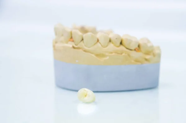 Ceramic crowns on a mold — Stock Photo, Image