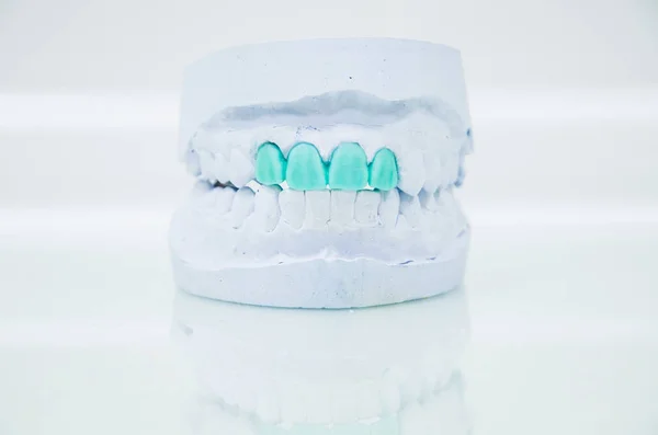 Yapay diş, mum modeli