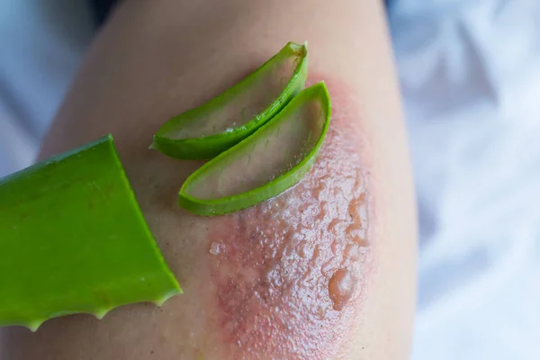 Trattamento dell'aloe vera nelle vesciche causate da un incendio . — Foto Stock