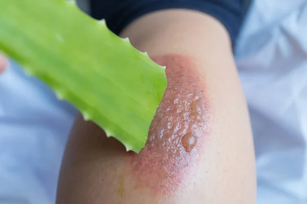 Tratamento com Aloe vera nas bolhas causadas por um incêndio . — Fotografia de Stock
