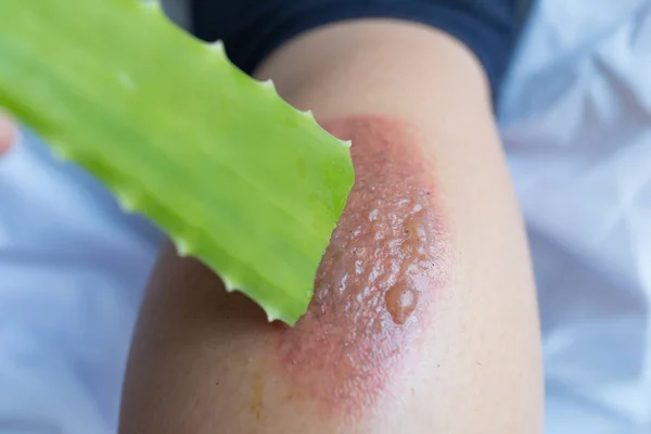 Tarafından yangını kabarcıklar tedavisinde aloe vera.