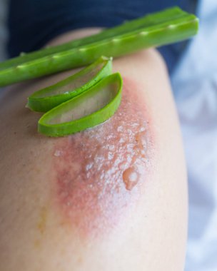 Tarafından yangını kabarcıklar tedavisinde aloe vera.