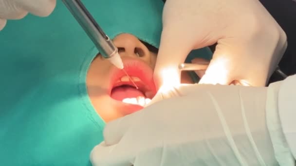 歯医者は歯の治療の前に子供の歯茎に麻酔注射を行います — ストック動画