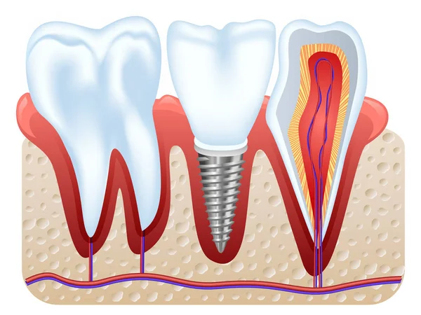Estrutura do implante dentário — Vetor de Stock