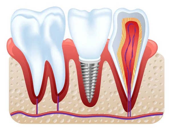 Estrutura do implante dentário —  Vetores de Stock