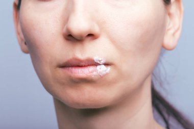 Genç kadının ağzına Herpes virüsü