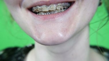 Diş telleri. Diş telleri ile kız gülümsüyor. Yeşil RIR