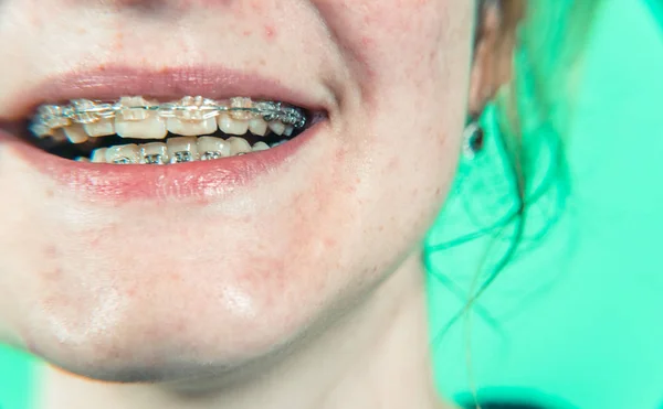 Braces. The girl with braces is smiling. Green rir — Stock Photo, Image