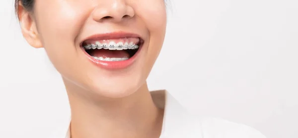 歯にブレースを持つ若い笑顔アジアの女性の顔 矯正治療 — ストック写真