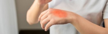 Woman hand has red skin rash itch, The cause is due to allergies to creams or air. clipart