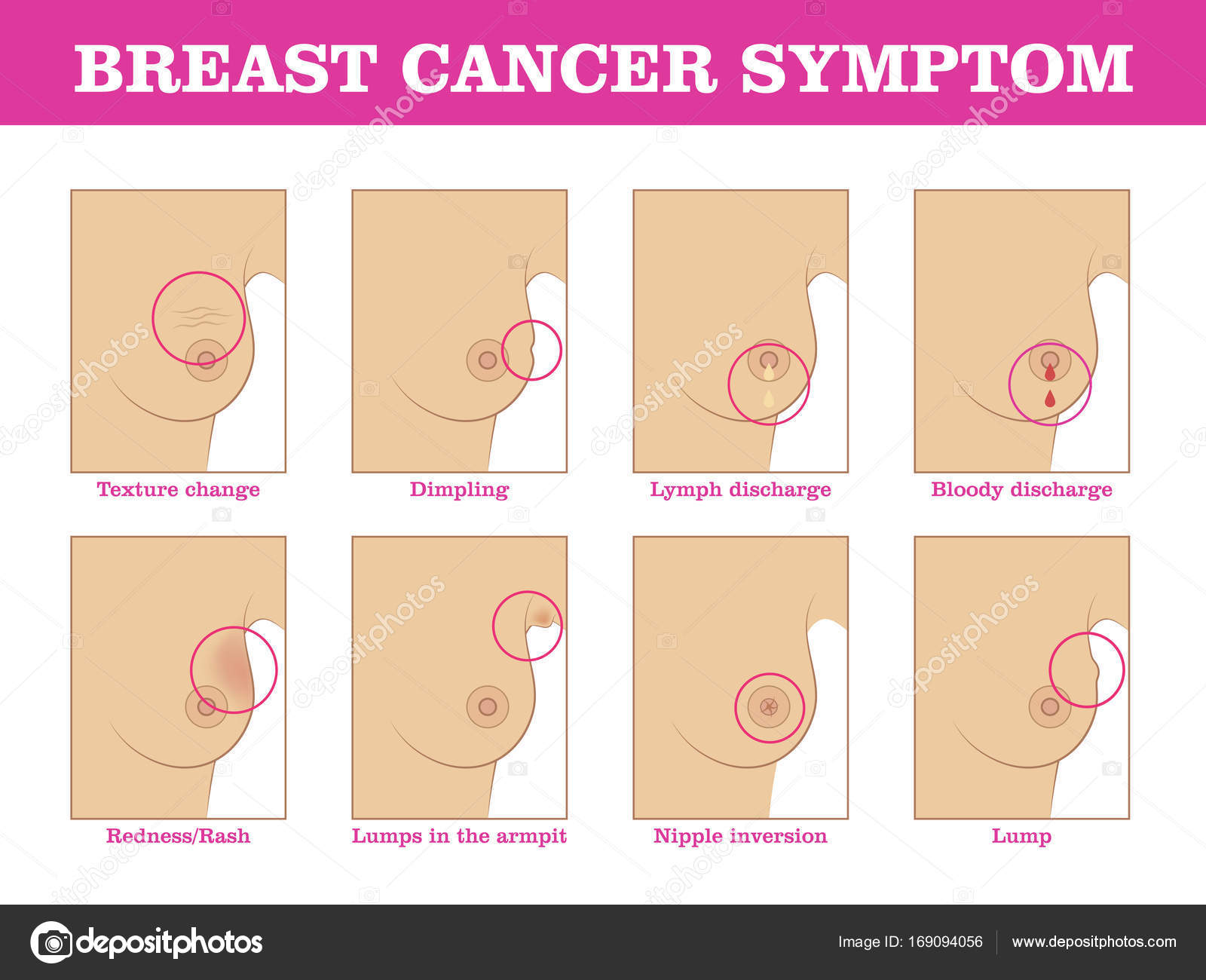 hormonell bröstcancer symtom hormonell bröstcancer symtom