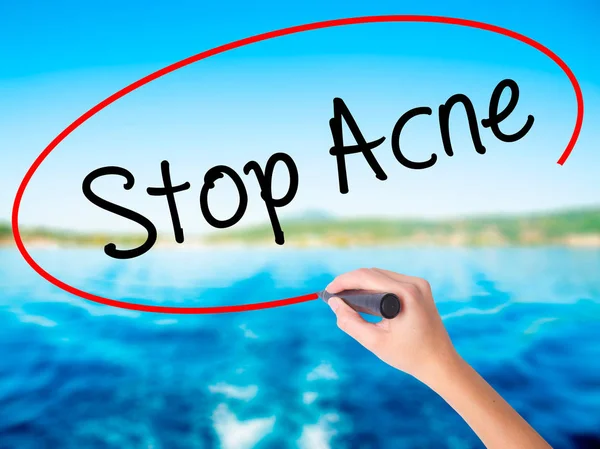 Woman Hand Writing Stop Acne  with a marker over transparent boa — Stock Photo, Image