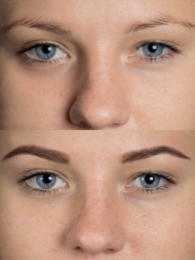 Düzeltme sonrasında önce göz kaşları 