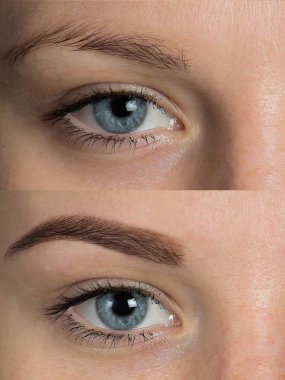 Düzeltme sonrasında önce göz kaşları 