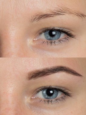 Düzeltme sonrasında önce göz kaşları 