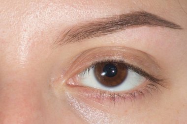 Düzeltme sonrasında büyük göz kaş