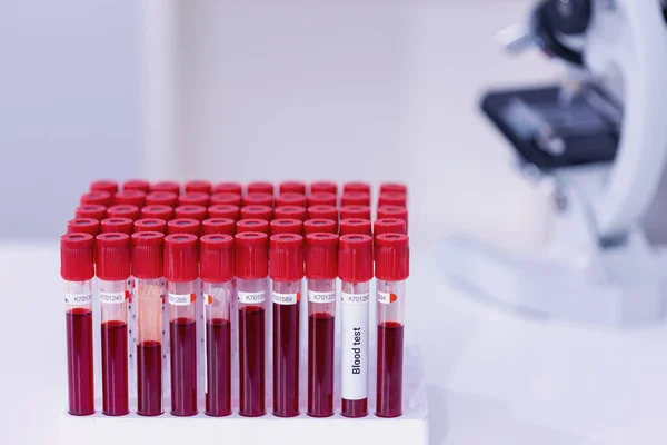 Muestra de sangre infectada con Covid-19 en tubo y microscopio en la mesa del laboratorio de investigación — Foto de Stock