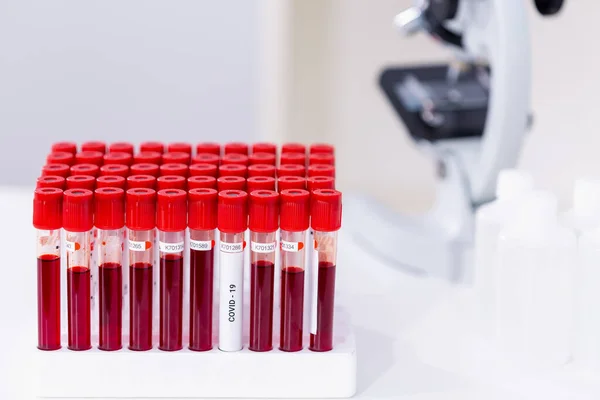 Muestra de sangre infectada con Covid-19 en tubo y microscopio en la mesa del laboratorio de investigación — Foto de Stock