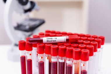 Enfeksiyon kapmış kan örneği tüpte ve mikroskopta araştırma laboratuarındaki masada.