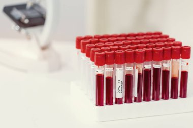 Enfeksiyon kapmış kan örneği tüpte ve mikroskopta araştırma laboratuarındaki masada.
