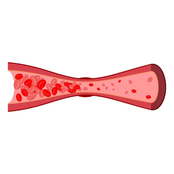 Coágulo sanguíneo en vena aislada. Enfermedad de los vasos sanguíneos en espalda blanca — Vector de stock