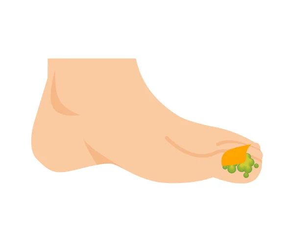 Bacaklarda Mantar Tırnak Hastalığı Ayak Parmağı Enfeksiyonu Vektör Illüstrasyonu — Stok Vektör