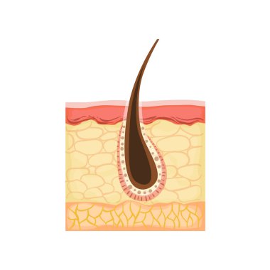 Dermatology Skincare Anatomical Info Illustration Demonstrating Skin Problem Development With Hair Root Inflammation clipart