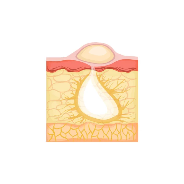 Dermatologia Skincare Informações anatômicas Ilustração Demonstração Pimple Desenvolvimento de problemas de pele — Vetor de Stock