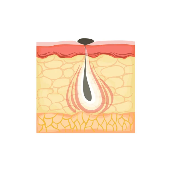 Dermatology Skincare Anatomical Info Illustration Demonstrating Acne Skin Problem Development — Stock Vector