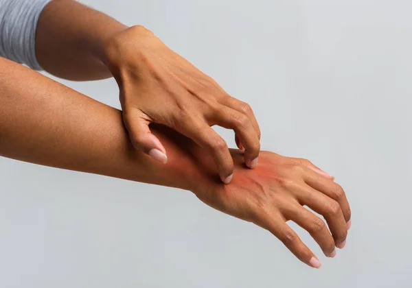 Женщина чешет руку, страдает псориазом — стоковое фото