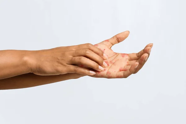 Afro mujer teniendo eczema en su palma —  Fotos de Stock