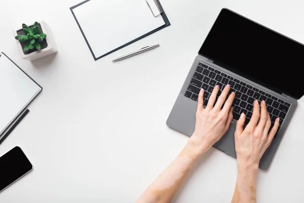 Mâini de sex feminin cu vitiligo care lucrează pe laptop modern — Fotografie, imagine de stoc