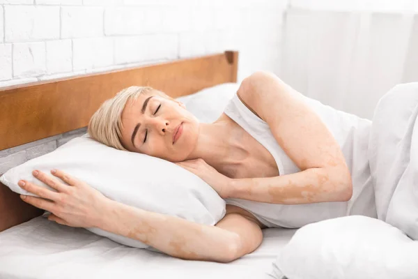 成熟睡眠不足妇女与白癜风病的特征描述 — 图库照片