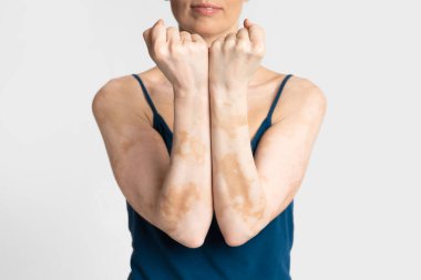 Kendinle savaşıyorsun. Vitiligo 'lu insanların korkusu