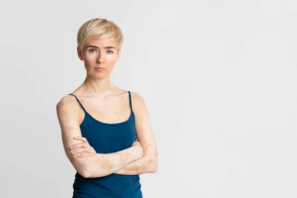 Aparência distinta. Loira bonito mulher com vitiligo — Fotografia de Stock