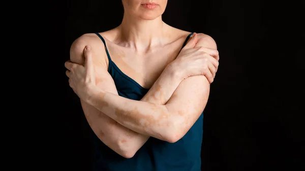 Женщина, страдающая хроническим заболеванием кожи — стоковое фото