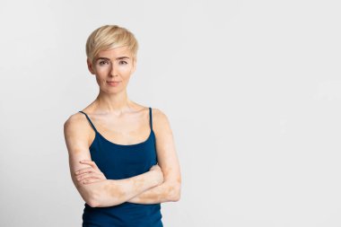 Melanin kaybetmiş bir kadının yaşam tarzı.
