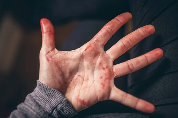 Кровотеча з відрізка пальця — стокове фото