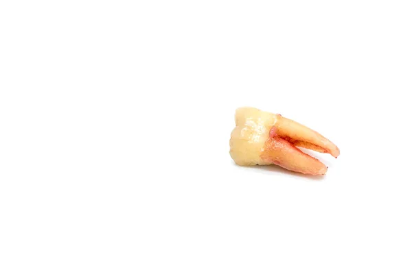 Αφαίρεση σπασμένο δόντι με τερηδόνα σε λευκό — Φωτογραφία Αρχείου