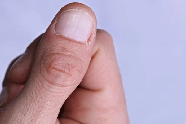 Uomo mani da vicino, cuticola secca, concetto di cura della pelle ruvida — Foto Stock