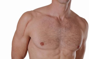 Adam adam elini omzuna beyaz arka plan üzerinde izole bir yara izi ile. Lazer yara izi azaltma kavramı
