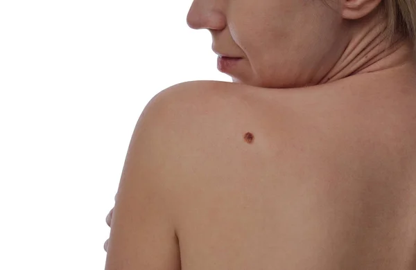 Checking benign moles : Woman with birthmark on her skin isolated on white background. — Stock Photo, Image