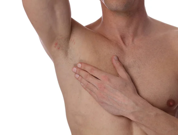 Male armpit with irritation after shaving, underarm razor burn — Stock Photo, Image