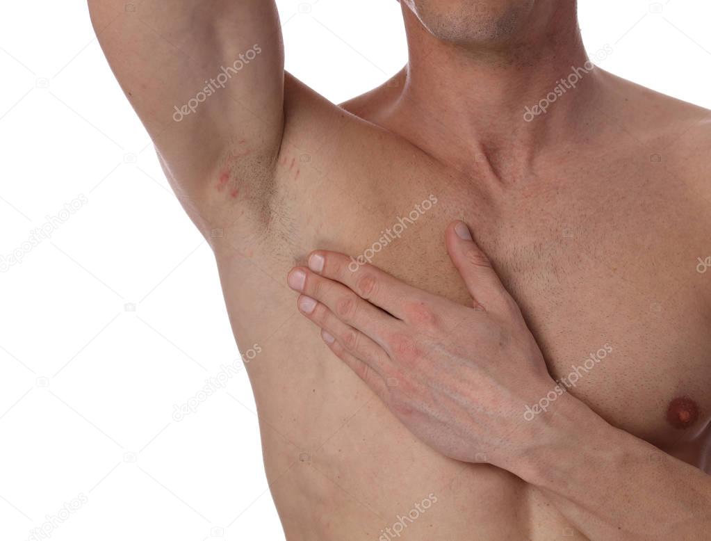 Male armpit with irritation after shaving, underarm razor burn