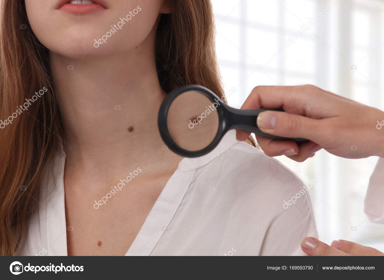 moedervlek verwijderen dermatoloog moedervlek verwijderen dermatoloog
