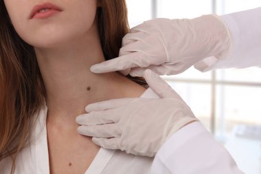 Doktor dermatolog inceliyor hasta doğum izine benzer kadar yakın. İyi huylu benler kontrol. Cilt etiketleri kaldırma lazer