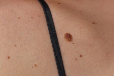 İyi huylu benler kontrol, kadın arka doğum lekeleri yakın çekim.